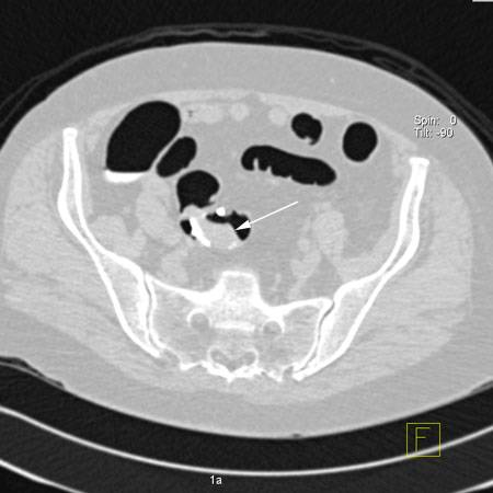 virtual colon: Large 2.5 cm polyp sigmoid on stalk - CTisus CT Scan