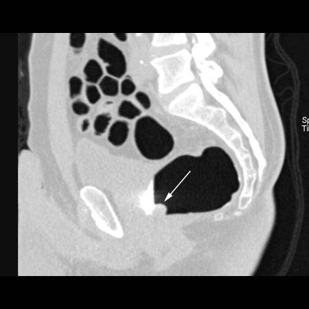 virtual colon: Large 1.2 cm polyp rectum - CTisus CT Scan