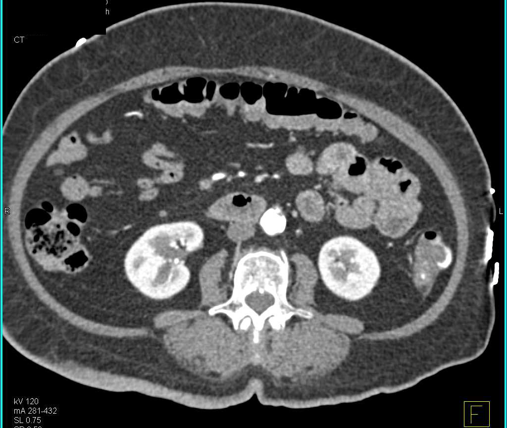 Active Bleed Left Colon due to Diverticulitis Best Seen on Venous Phase - CTisus CT Scan