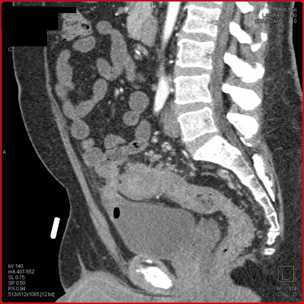 Diverticulitis with Fistulae to Bladder Best Seen on Sagittal Images - CTisus CT Scan