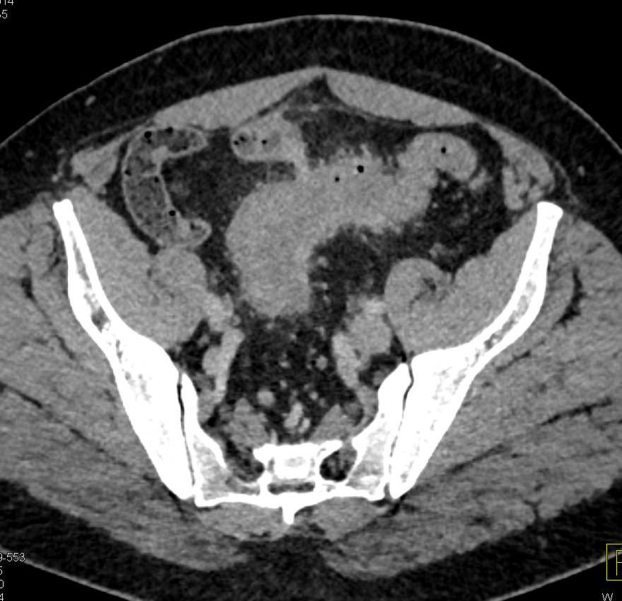 Diverticulitis with Fistulae to Bladder Best Seen on Sagittal Images - CTisus CT Scan