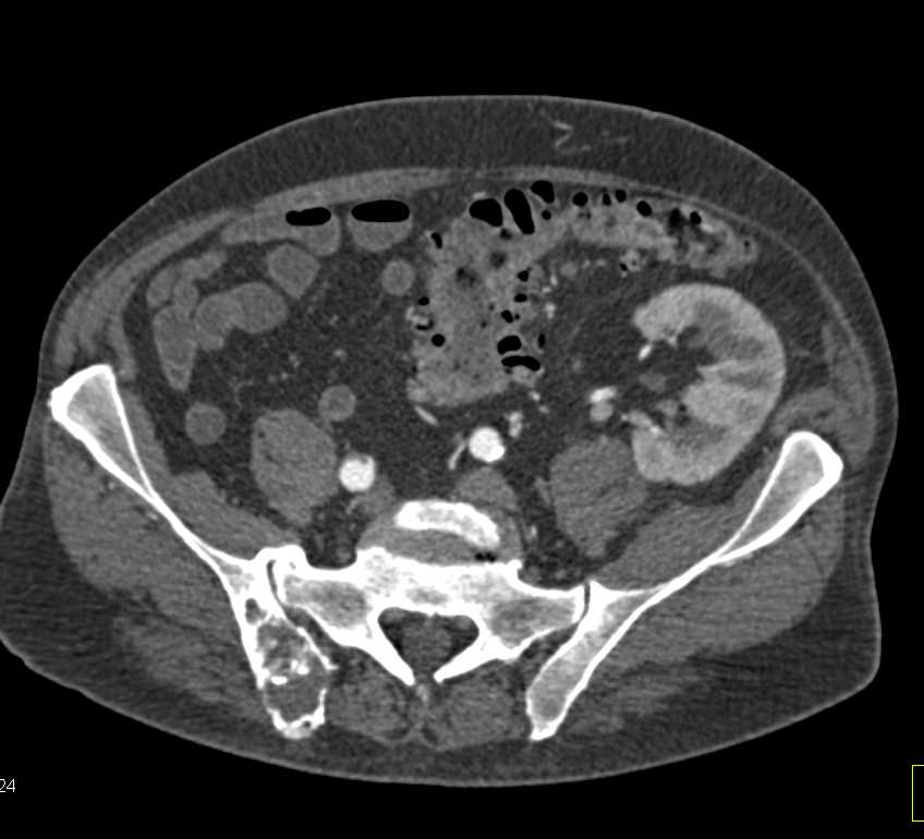 Sigmoid Colon Cancer Invades the Bladder with Bone Metastases - CTisus CT Scan