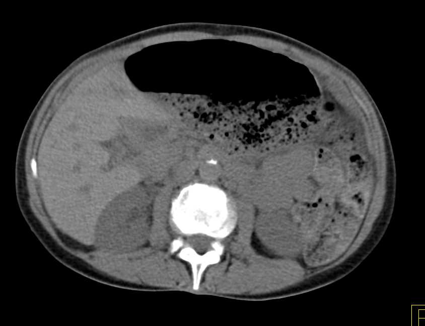 Sigmoid Volvulus - CTisus CT Scan