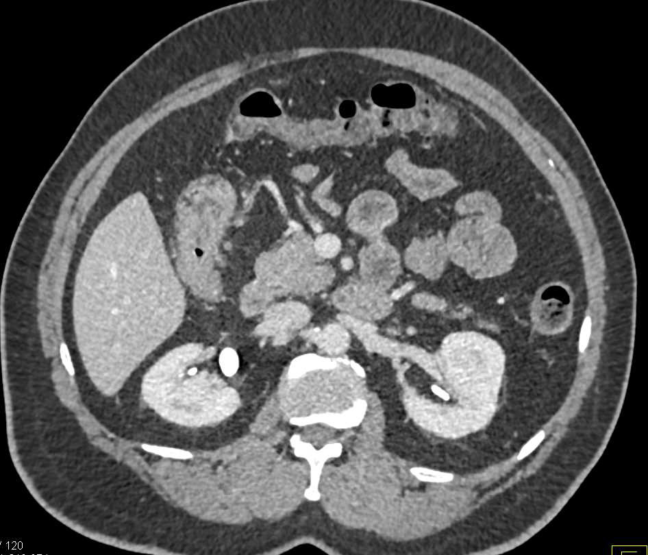 Carcinoma of the Hepatic Flexure - CTisus CT Scan