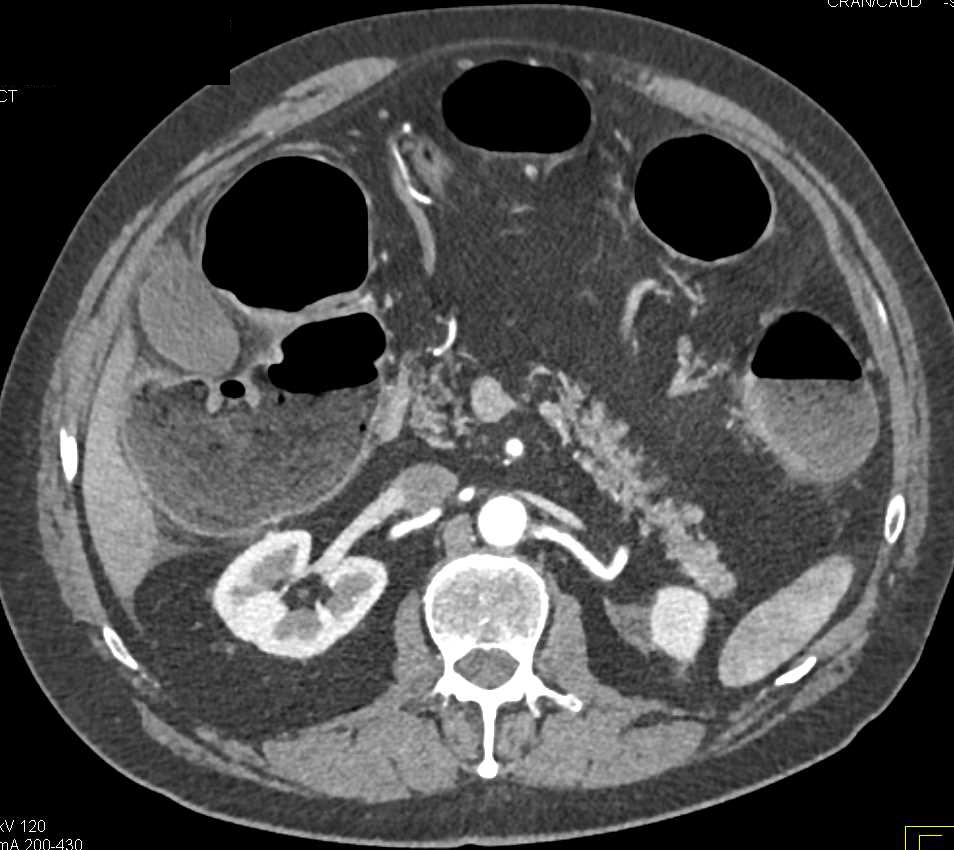 Multifocal Colon Cancer - CTisus CT Scan