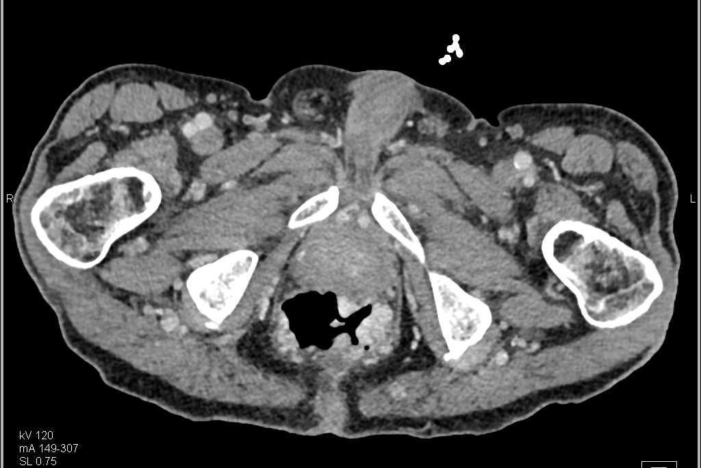 Rectal Varices and Cirrhosis of the Liver in Gastrointestinal (GI) Bleed Patient - CTisus CT Scan