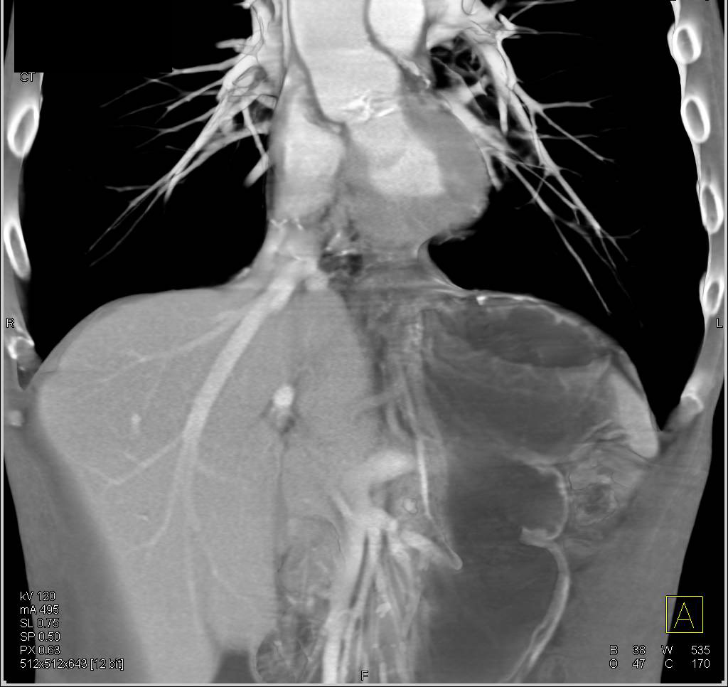 Esophageal Cancer - CTisus CT Scan