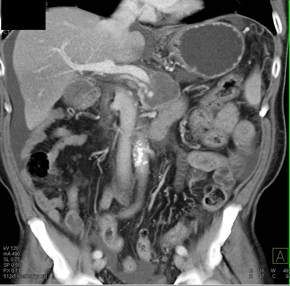 Retroperitoneal Tumor Invades and Involves Left Kidney and Pancreas with Encasement - CTisus CT Scan