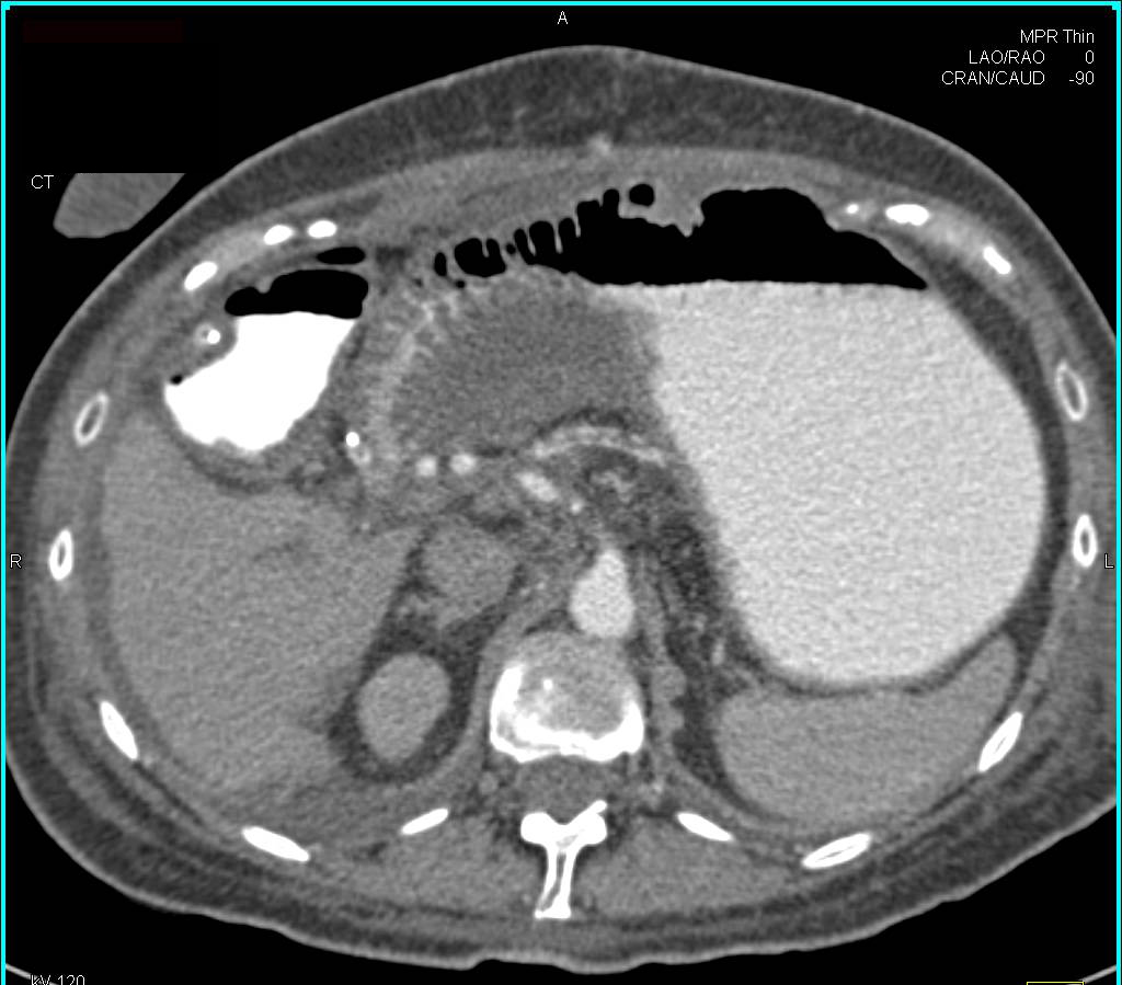 Peritoneal Inflammation with Small Bowel Inflammation - CTisus CT Scan