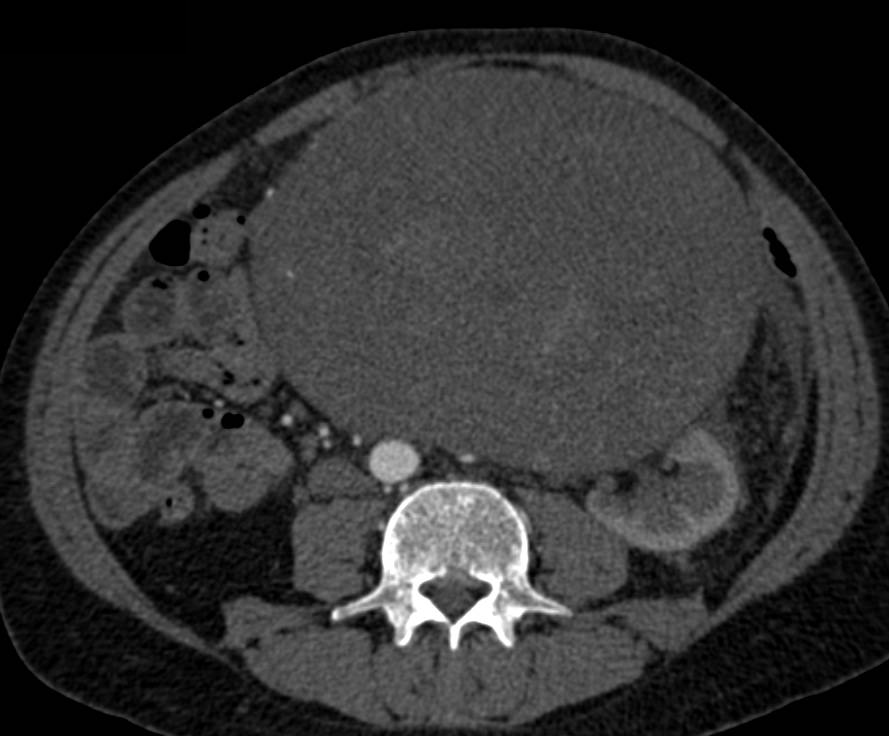 Retroperitoneal Sarcoma was a Neurogenic Sarcoma - CTisus CT Scan
