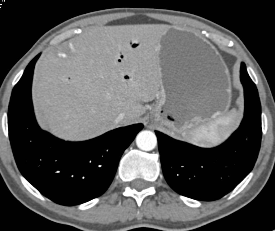 Acute Cholecystitis in a Patient with Vessel Encasement due to Panceatic Cancer. The PV/SMV confluence is especially encased - CTisus CT Scan