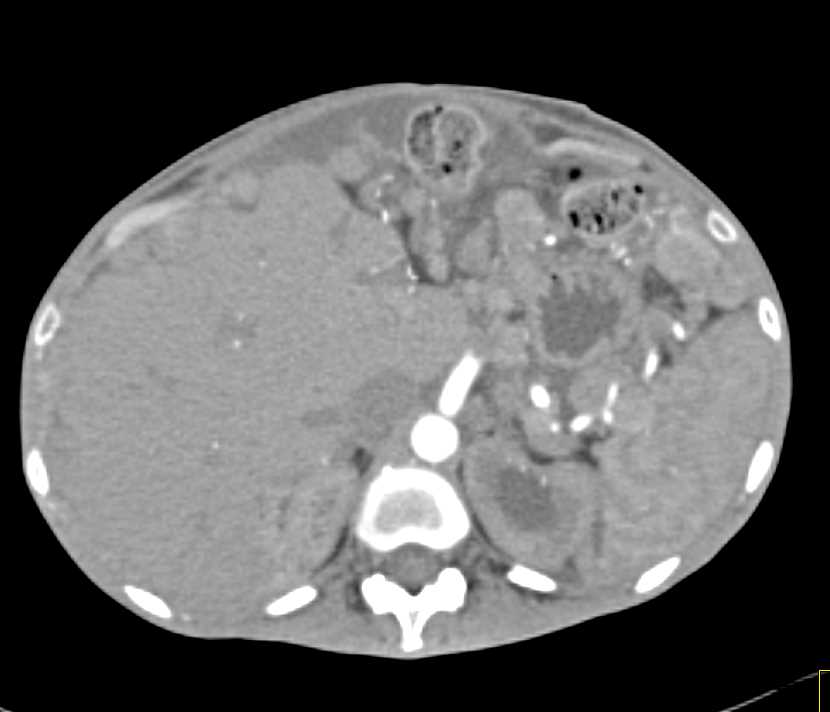 Extensive Tumor Implants Throughout the Abdomen due to GIST Tumor - CTisus CT Scan