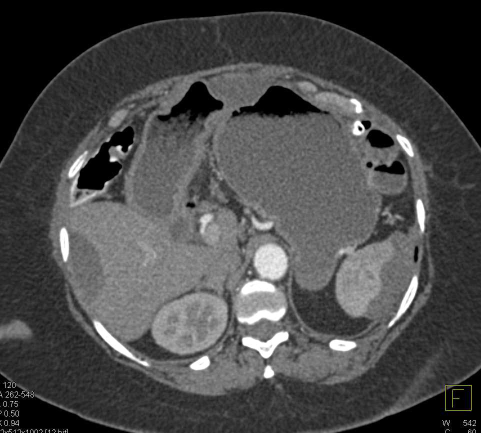 Pseudomyxoma Peritonea - CTisus CT Scan