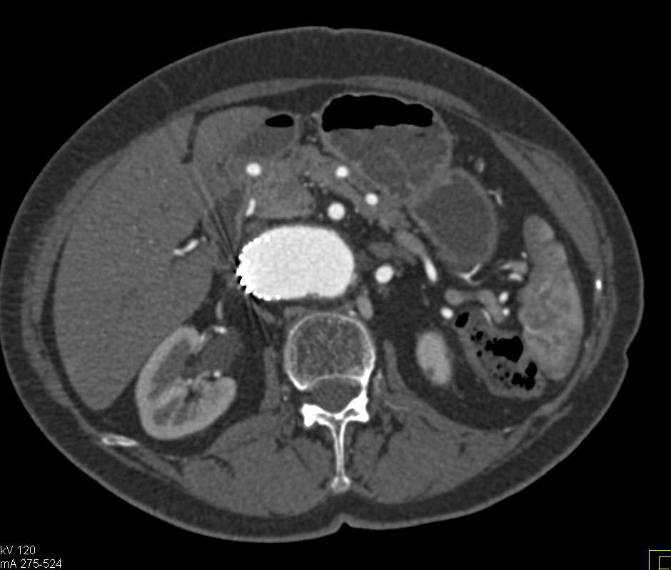 Rectal cancer in a Patient with Prior Aortic Aneurysm Repair - CTisus CT Scan