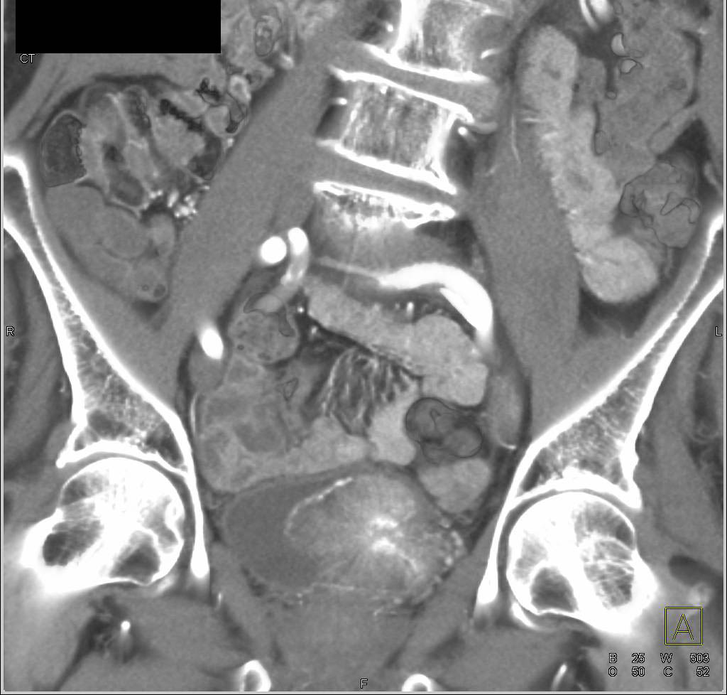 Bladder Cancer with CT Urography - CTisus CT Scan