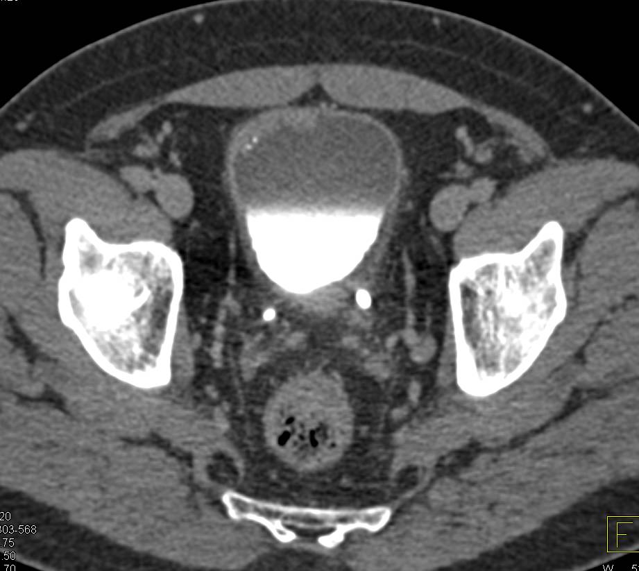 Transitional Cell Carcinoma of the Bladder - CTisus CT Scan