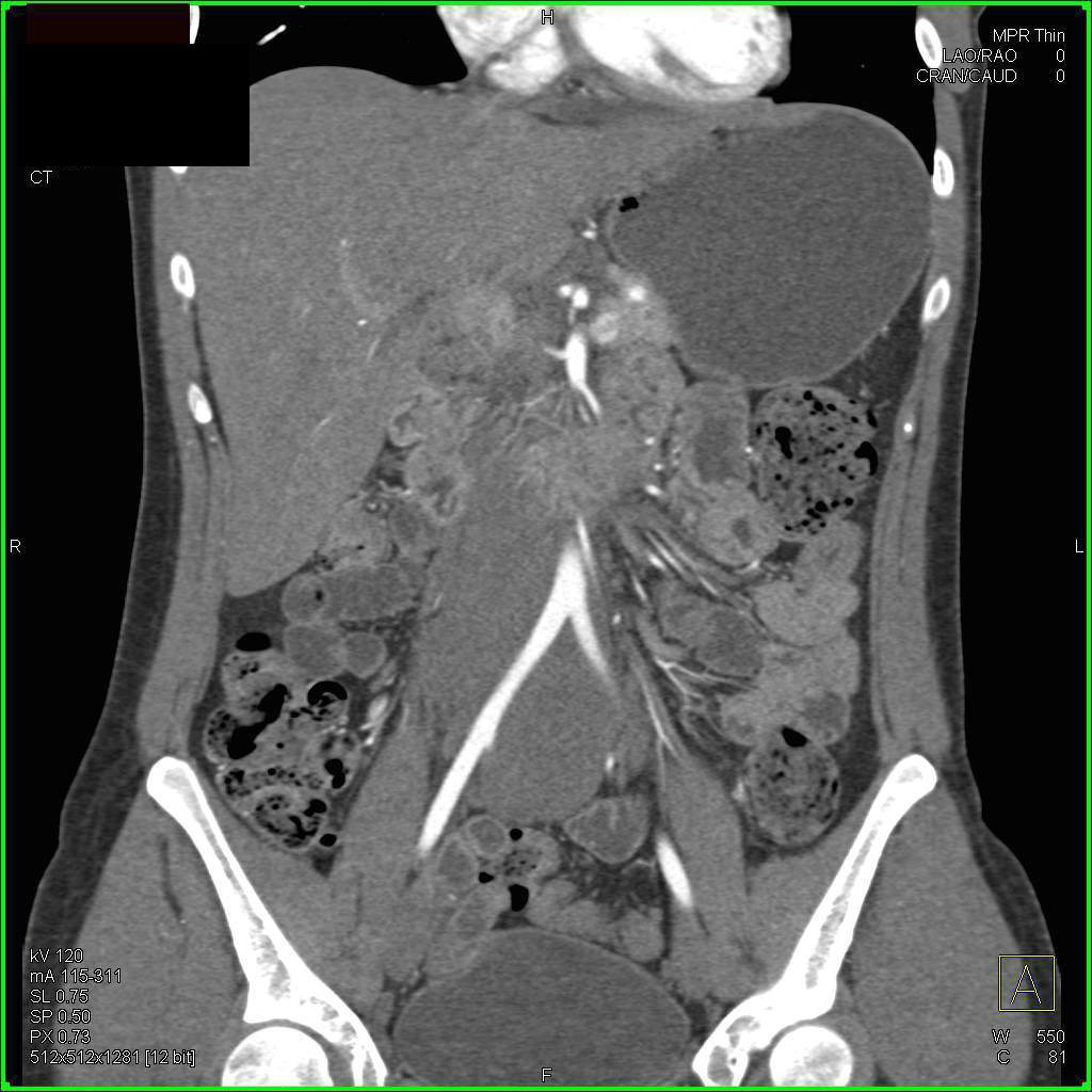 Unusual Appearance of Retroperitoneal Fibrosis Which Simulates a Neoplasm - CTisus CT Scan
