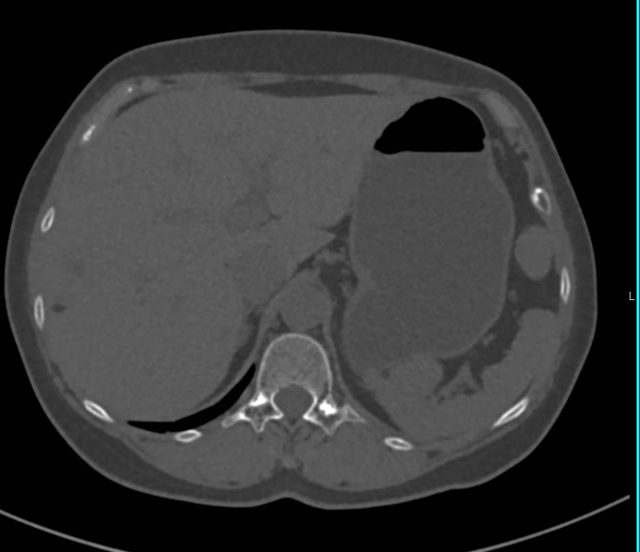 Incredible Case of Hepatic and Renal Angiomyolipomas - CTisus CT Scan