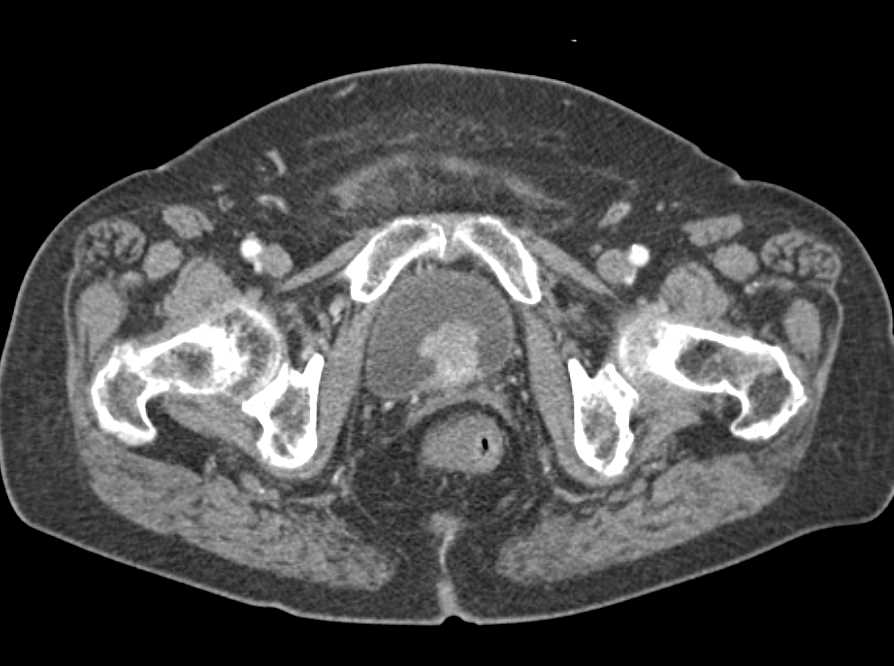 Bladder Cancer as an Incidental Finding - CTisus CT Scan