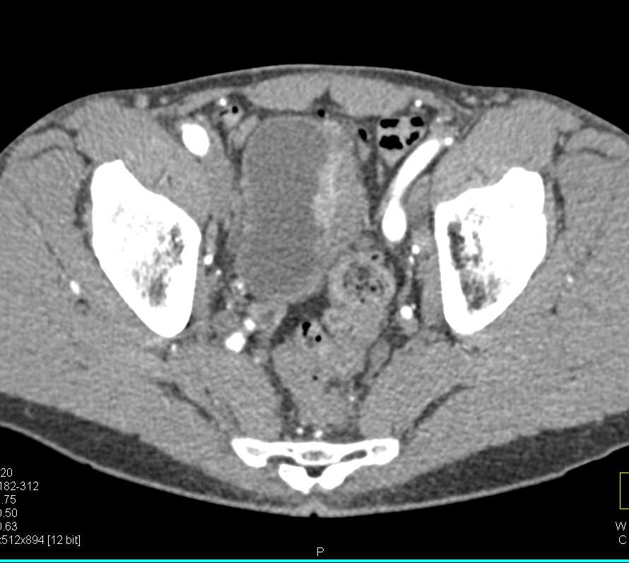 Infiltrating Bladder Cancer in Left Wall of Bladder - CTisus CT Scan