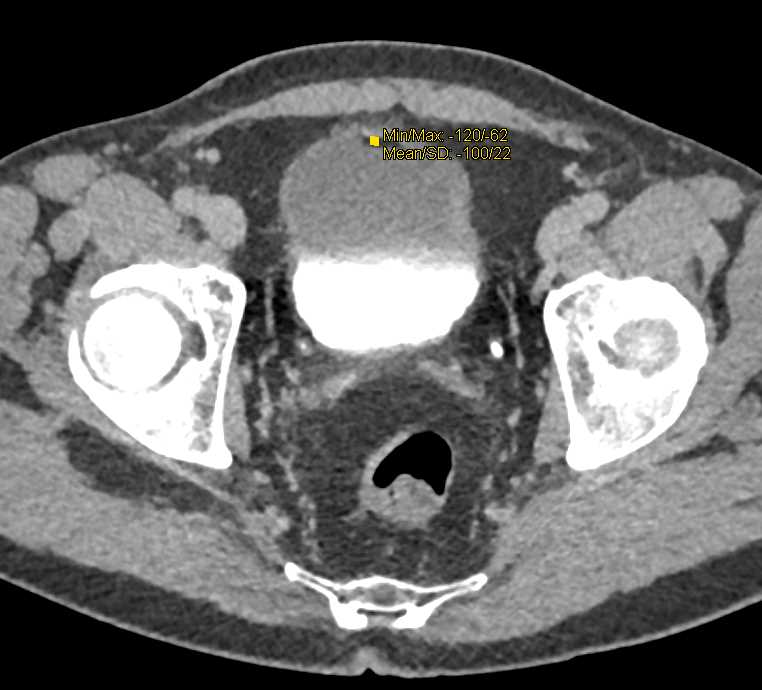 Focal Fat in Bladder s/p Partial Nephrectomy - CTisus CT Scan