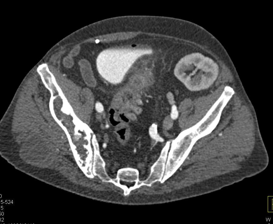 CT Cystogram with Colon Cancer Invading the Bladder - CTisus CT Scan