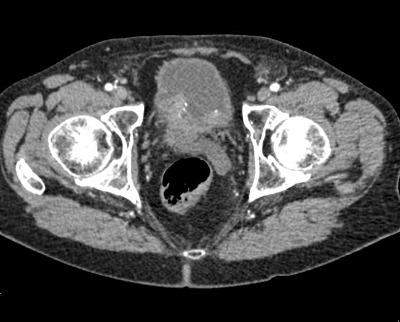 Bladder Cancer Near Right Ureterovesical Junction (UVJ) - CTisus CT Scan