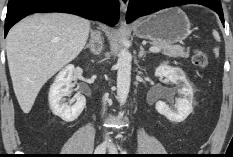 Carcinoma at the Ureterovesical Junction (UVJ) - CTisus CT Scan