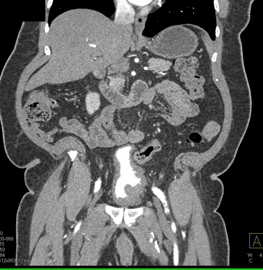 Infiltrating Bladder Cancer - CTisus CT Scan