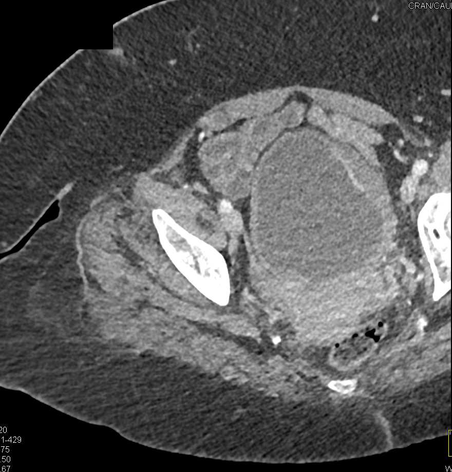 Bladder Cancer - CTisus CT Scan