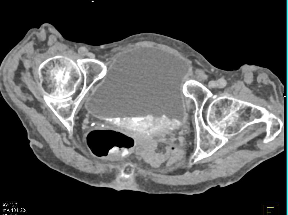 Infiltrating Tumor Posterior Bladder Wall - CTisus CT Scan