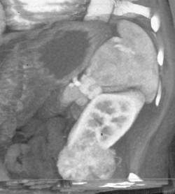 Vascular Renal Cell Carcinoma - CTisus CT Scan