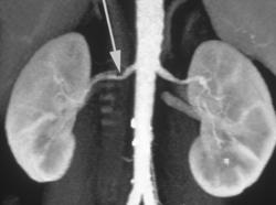 Focal Renal Artery Stenosis - CTisus CT Scan