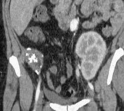 Failed Right Iliac Fossa Renal Transplant That Is Calcified - CTisus CT Scan