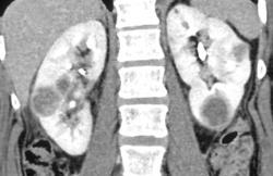 Multiple Renal Metastases From Lung Cancer - CTisus CT Scan