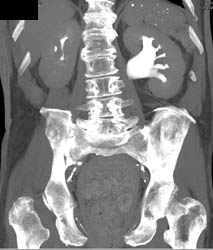 Transitional Cell Carcinoma - CTisus CT Scan