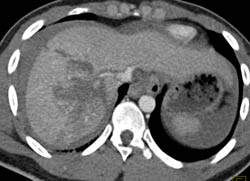 Liver Laceration With Bleed and Renal Laceration - CTisus CT Scan