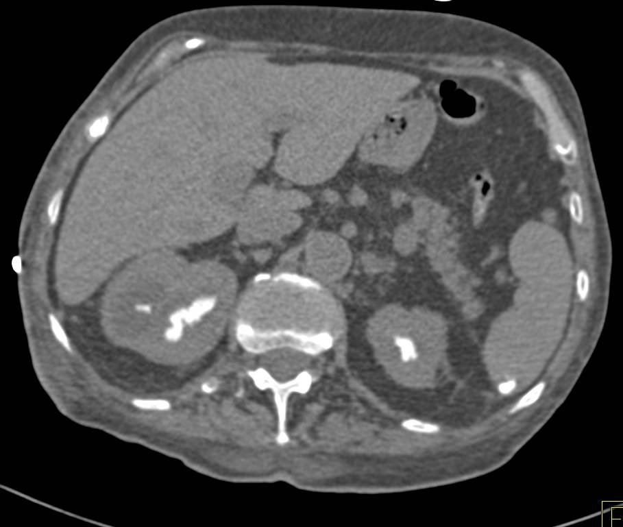 Acute Pyelonephritis with Blunted Calyces - CTisus CT Scan