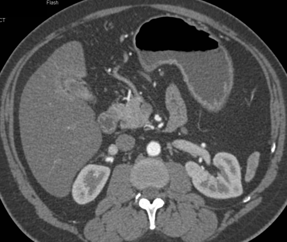 Incidental Gallbladder Cancer Simulates Inflammatory Disease - CTisus CT Scan