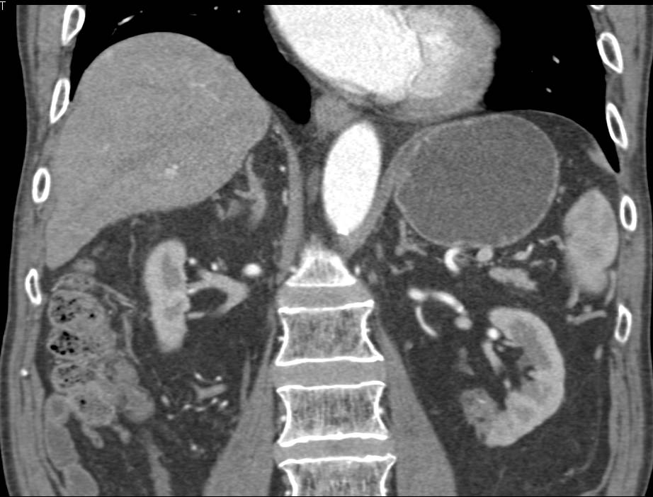 Scarring Lower Pole of Left Kidney - CTisus CT Scan