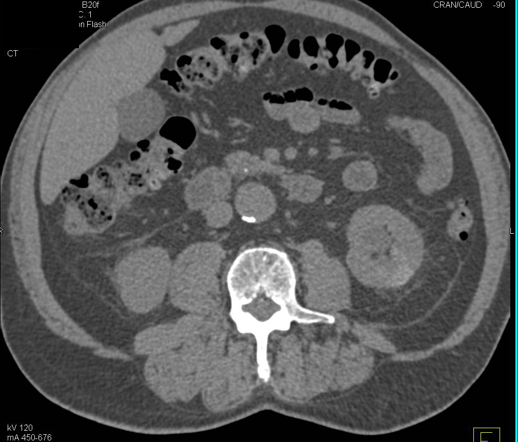 Prior Cryoablation of Mass in Lower Pole of the Left Kidney - CTisus CT Scan