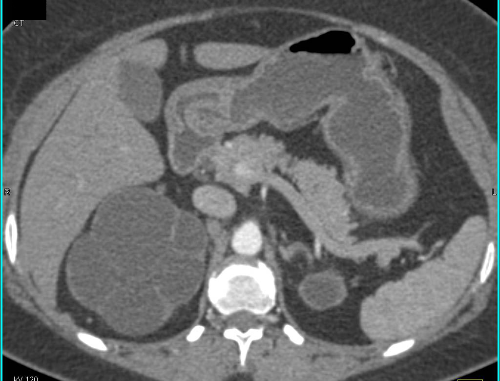 Obstructed Calyces Right Kidney with Renal Calculi. Left Kidney is Atrophic. - CTisus CT Scan