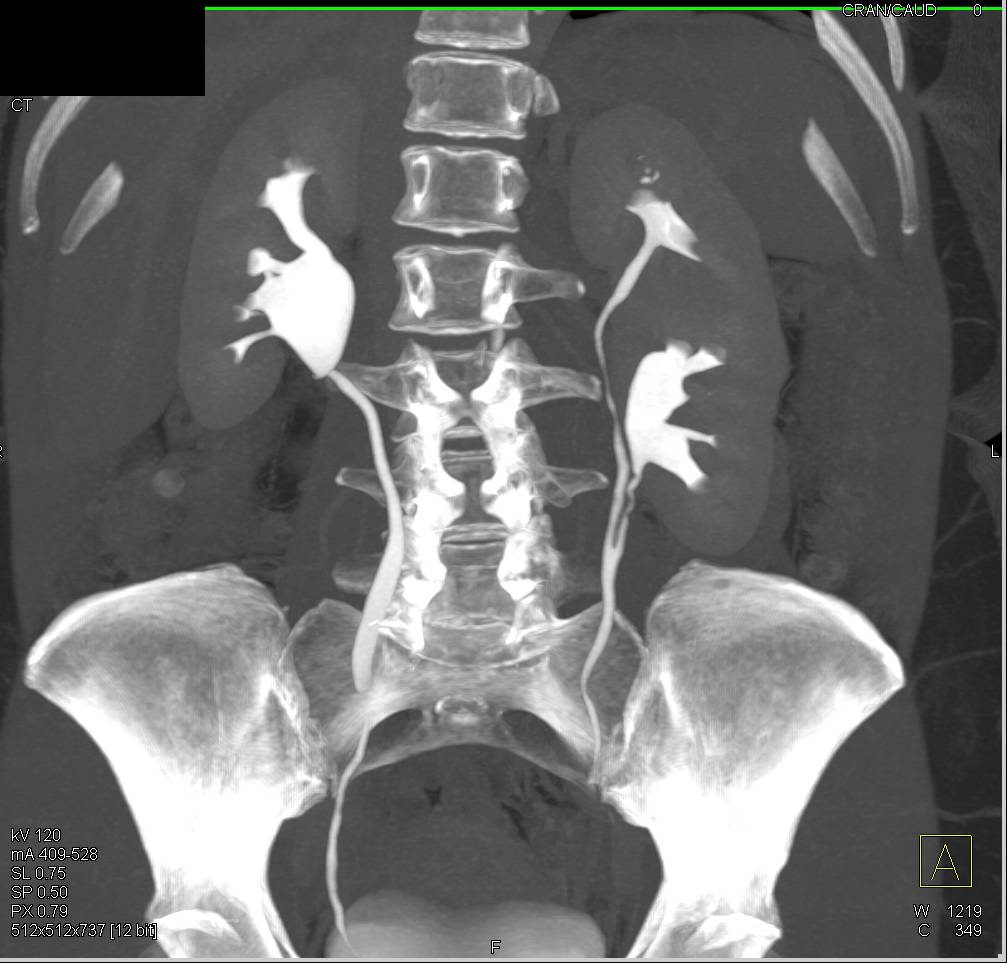CT Urogram with Duplicated Collecting System on the Left - CTisus CT Scan
