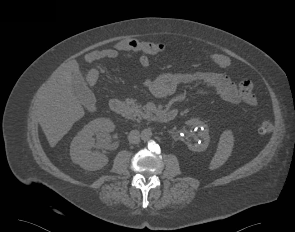 2 cm Renal cell Carcinoma Near Hilum of Right Kidney in Patient with Atrophic Left Kidney - CTisus CT Scan