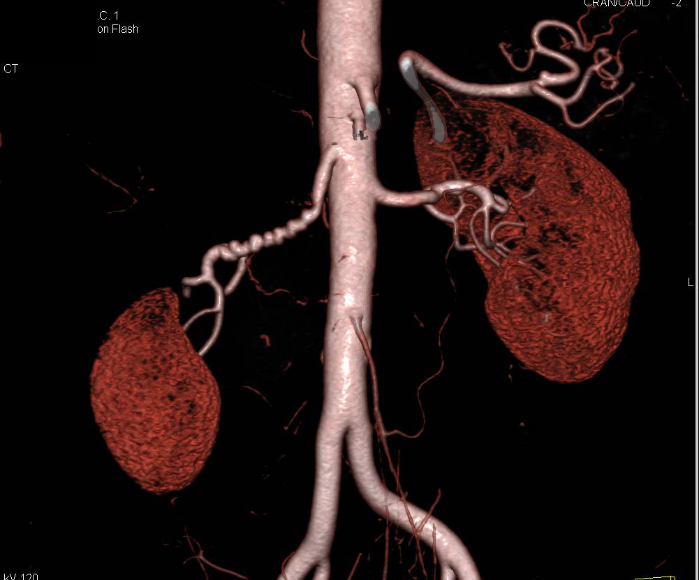 Fibromuscular Dysplasia Right Renal Artery (FMD) and to lesser Degree the Left Renal Artery - CTisus CT Scan