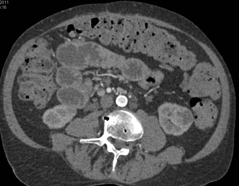 Subtle Left Lower Pole Papillary Renal Cell Carcinoma - CTisus CT Scan