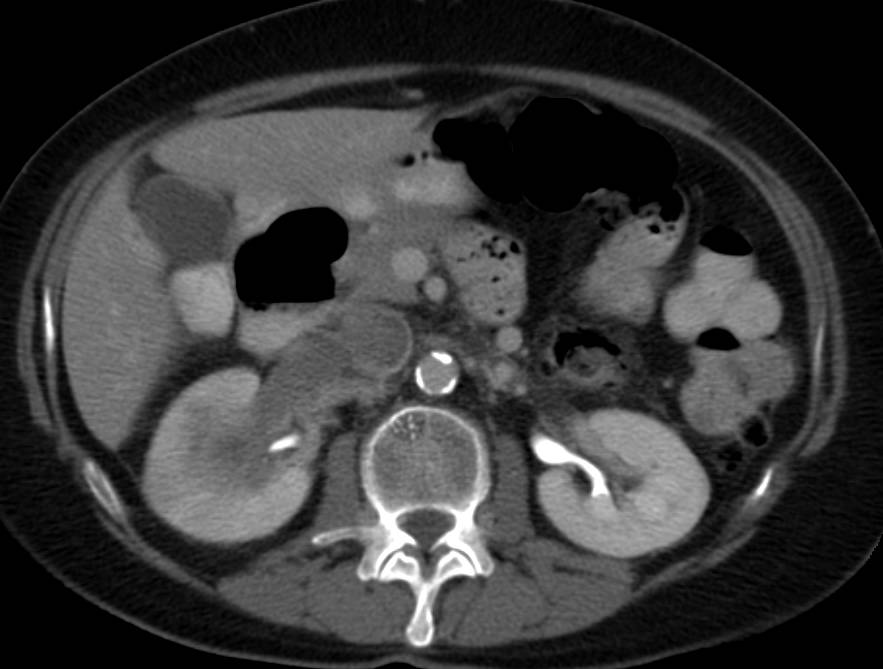 Transitional Cell Carcinoma with Renal Vein and Inferior Vena Cava (IVC) Extension - CTisus CT Scan