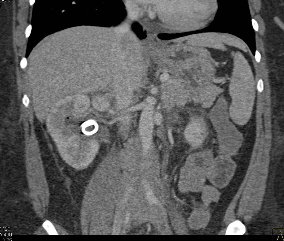 Retroperitoneal Fibrosis with Bilateral Hydronephrosis - CTisus CT Scan