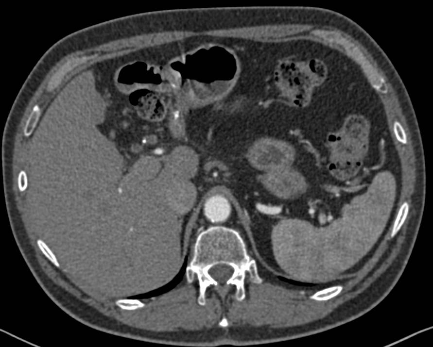 Right Nephrectomy with Vascular Liver Metastases - CTisus CT Scan