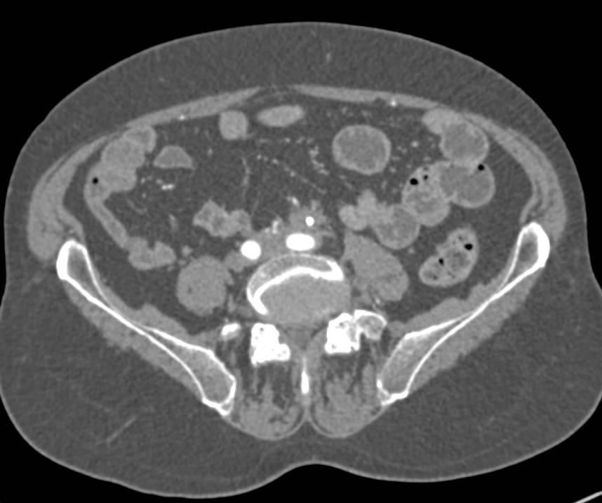Retroperitoneal Fibrosis Encases the Aorta and the Left Ureter - CTisus CT Scan